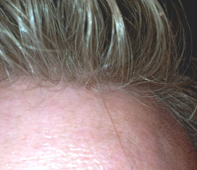 INFOLTIMENTO CAPELLI VERI - LA SOLUZIONE DEFINITIVA ALLA CALVIZIE! - Foto 5