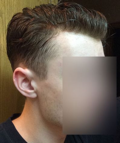INFOLTIMENTO CAPELLI VERI - LA SOLUZIONE DEFINITIVA ALLA CALVIZIE! - Foto 8