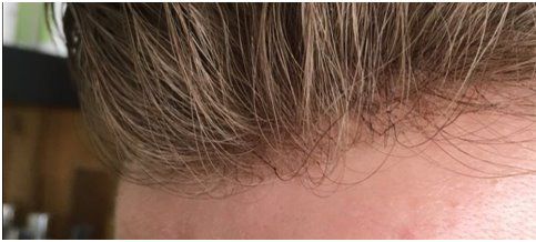 INFOLTIMENTO CAPELLI - PROTESI CAPILLARE - METODO HOLLYWOOD - Foto 7