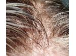 INFOLTIMENTO CAPELLI VERI - LA SOLUZIONE DEFINITIVA ALLA CALVIZIE!