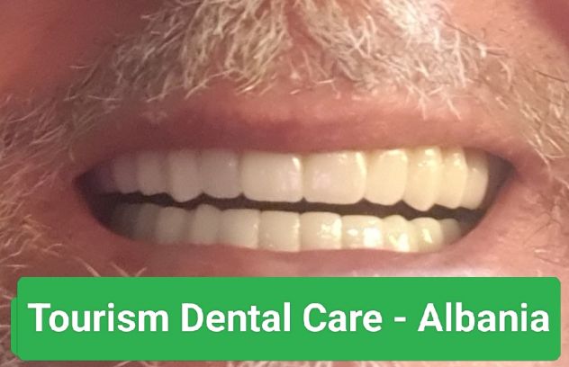 CURE DENTALI -ALBANIA - Foto 4