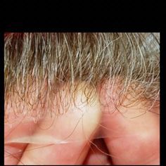 INFOLTIMENTO CAPELLI - PROTESI CAPILLARE - METODO HOLLYWOOD - Foto 8