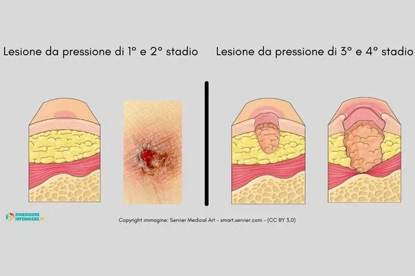 Medicazione piaghe, lesioni da pressione a domicilio, a Catania - Foto 3