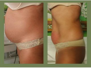 Massaggi - benessere Palermo - ELIMINARE IL GRASSO ADDOMINALE Tel:3203129913